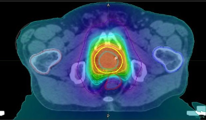 放射線治療計画