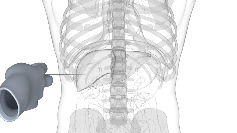フィデューシャルマーカ留置